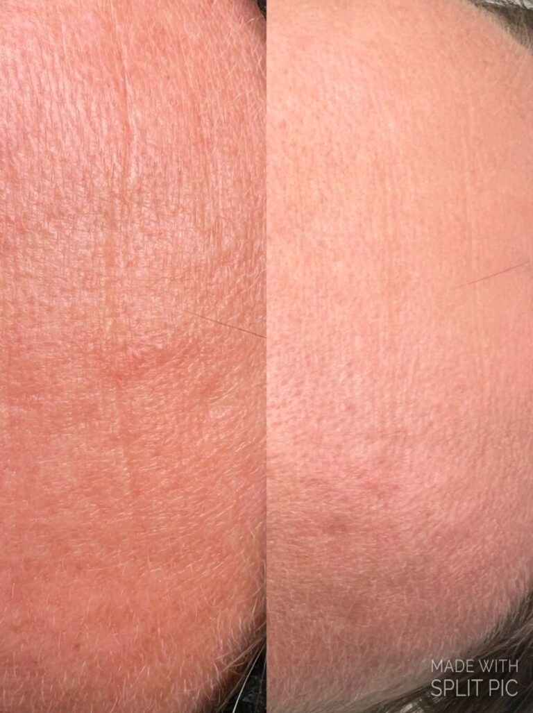 mezoterapia mikroigłowa czoła